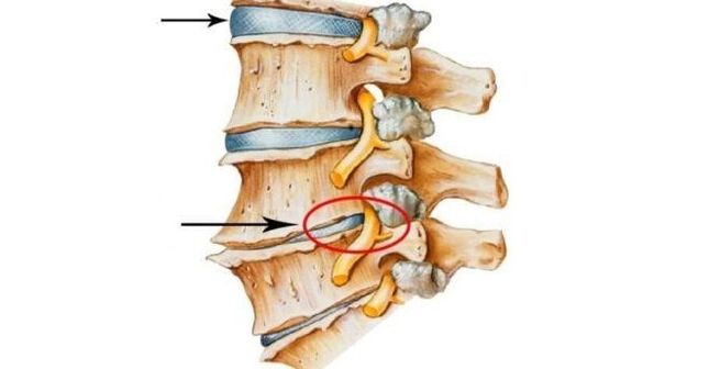 disco spinale sano e danneggiato con osteocondrosi cervicale