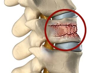 Le cause del mal di schiena possono essere malattie della colonna vertebrale e dei dischi intervertebrali. 