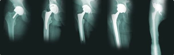 opzioni per la sostituzione dell'anca in artrosi