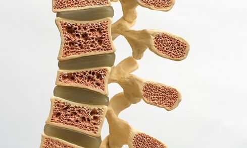 L’osteoporosi è una delle cause del mal di schiena