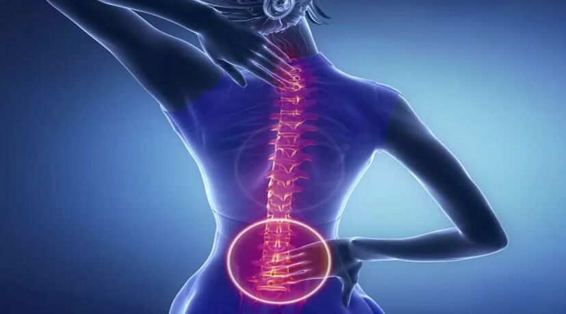 Osteocondrosi della colonna vertebrale