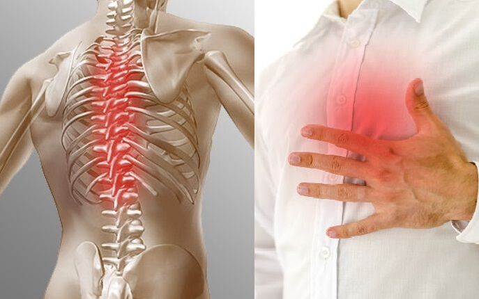 Osteocondrosi toracica e dolore toracico