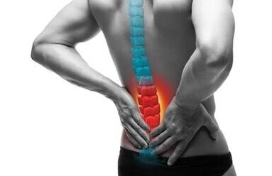 L'osteocondrosi è una malattia della colonna vertebrale