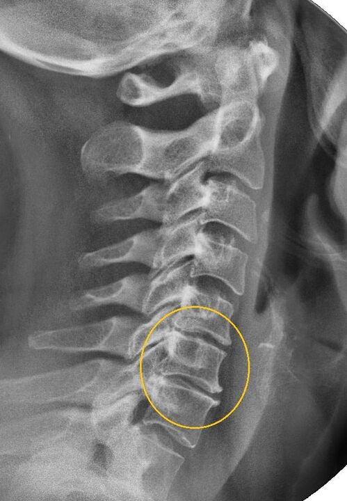 Osteocondrosi cervicale alla radiografia