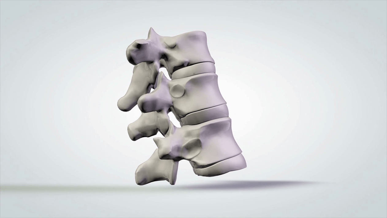 danno alla colonna vertebrale a causa dell'osteocondrosi cervicale