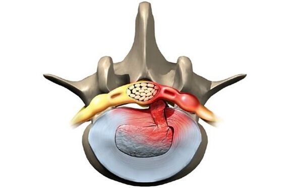 vertebra colpita da osteocondrosi