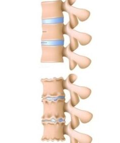 cause dell'osteocondrosi