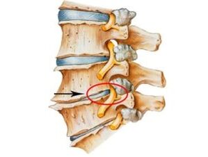 segni e sintomi di osteocondrosi